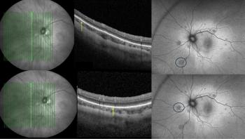 (Courtesy of Priyanka Sanghi, BSc, MSc, MBBS) FLORetina 2025: Rethinking Terson syndrome through multimodal imaging