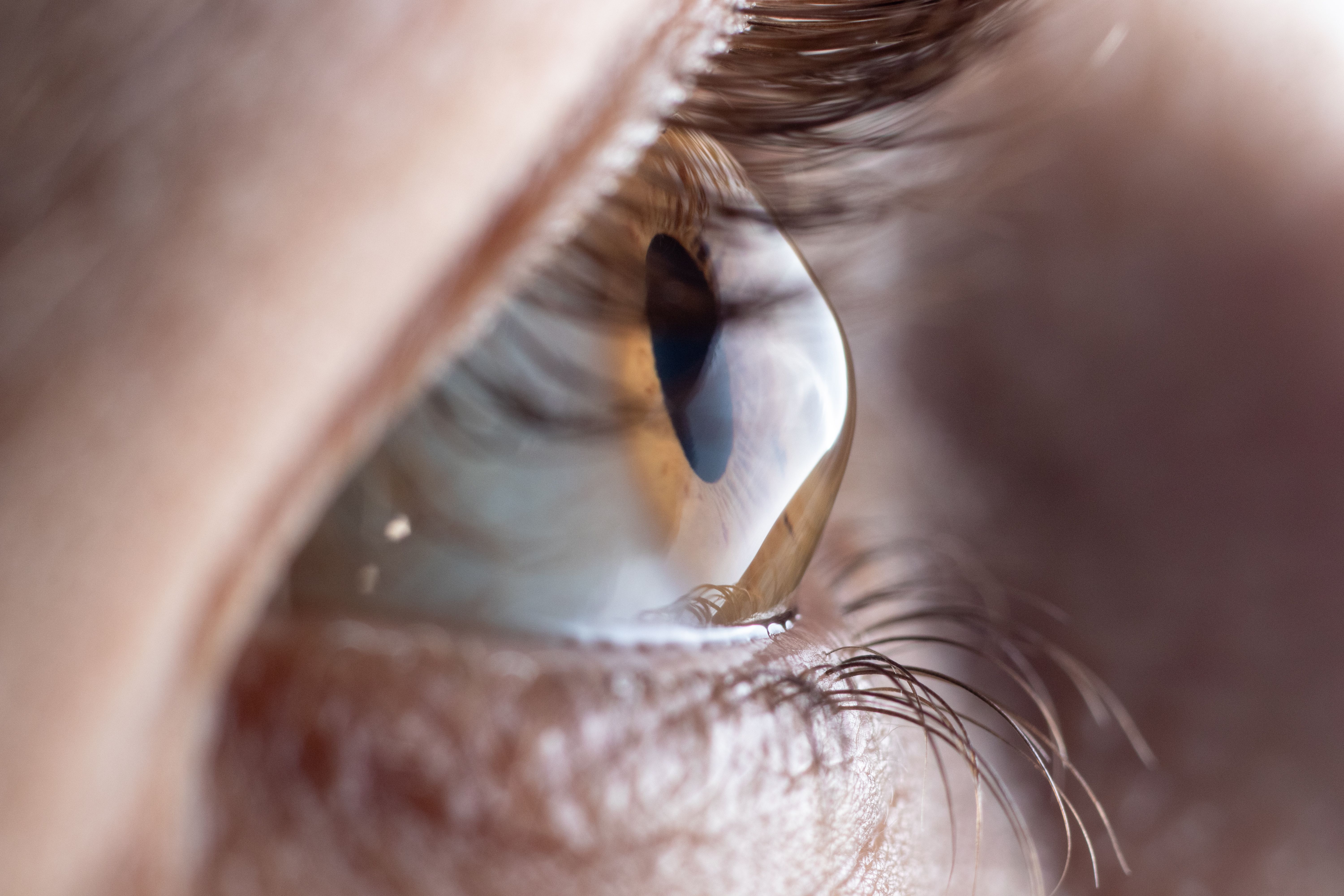 cone shaped cornea of eye