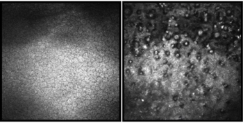 Figure. Slit-scanning in vivo confocal microscopy images of the corneal endothelium: A (left) demonstrates a healthy control cornea: Image of a normal corneal endothelium, showing a uniform hexagonal cell pattern with consistent cell density and no visible guttae or abnormalities (white solid arrowhead). B (right) shows FECD: Increased confluency of guttata, illustrating a more extensive presence of these structures. Images courtesy UCL/NIHR Moorfields Biomedical Research Centre.