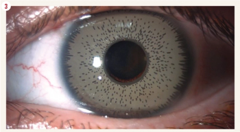 Cosmetic iris implants pose high risk of vision loss