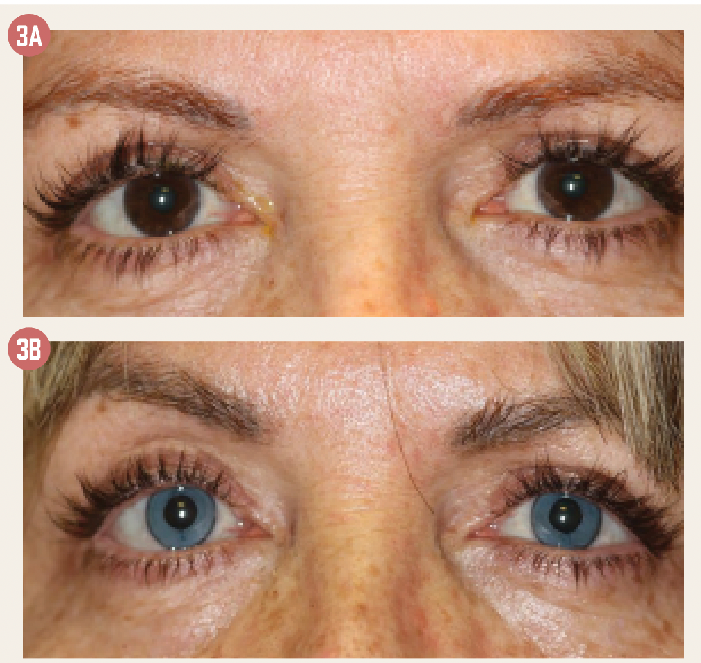 Figure 3. An example of cosmetic keratopigmentation. The patient, a 46-year-old woman, was from central Europe and wanted blue eyes like most of her family members. Photos taken before (A) and 3 years after (B) the procedure. Figure 3. An example of cosmetic keratopigmentation. The patient, a 46-year-old woman, was from central Europe and wanted blue eyes like most of her family members. Photos taken before (A) and 3 years after (B) the procedure.