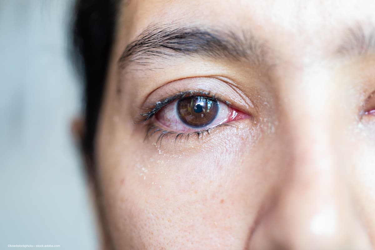 High performance microscopy for non-invasive conjunctival goblet cell examination examined by study
