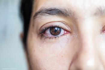 High performance microscopy for non-invasive conjunctival goblet cell examination examined by study