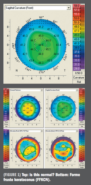 Exploring better imaging for LASIK