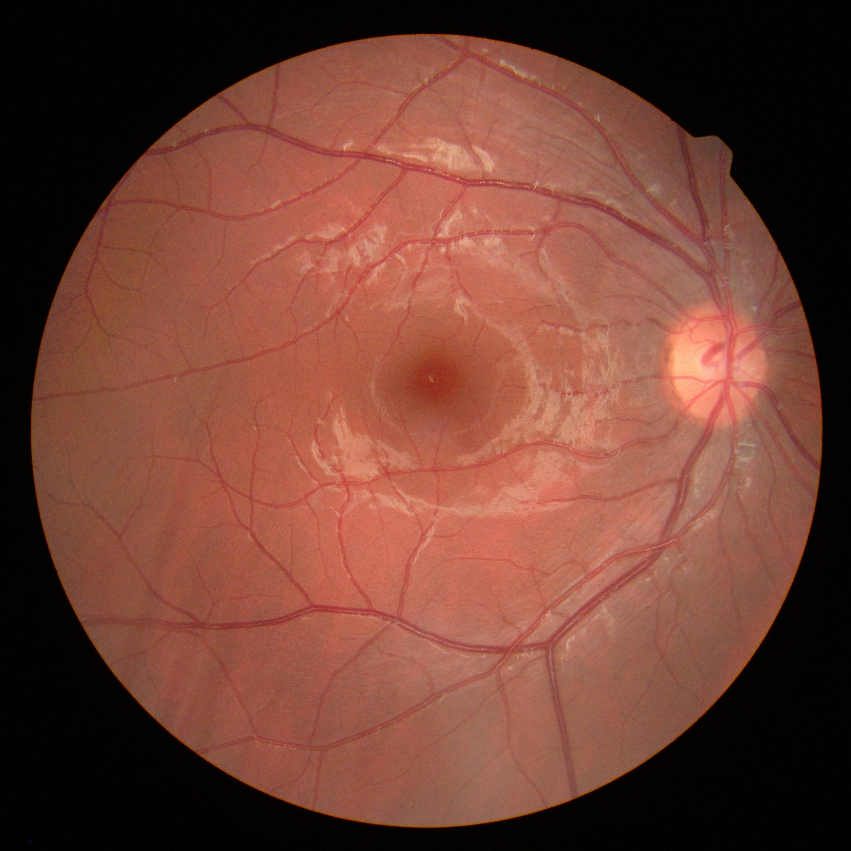 scan of eye showing macular oedema
