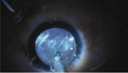 Shedding light on vitreous opacities during cataract surgery