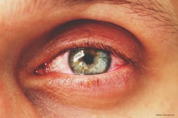 Sustained-release anti-inflammatory therapy proves valuable in NIU