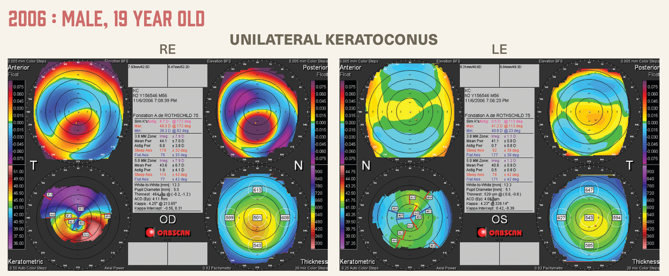 Figure 1: The right cornea is affected by keratoconus. The left cornea remains negative for all topographical and biomechanical indices of detection.