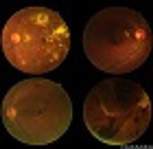 OCTA provides quantitative vessel density measurement