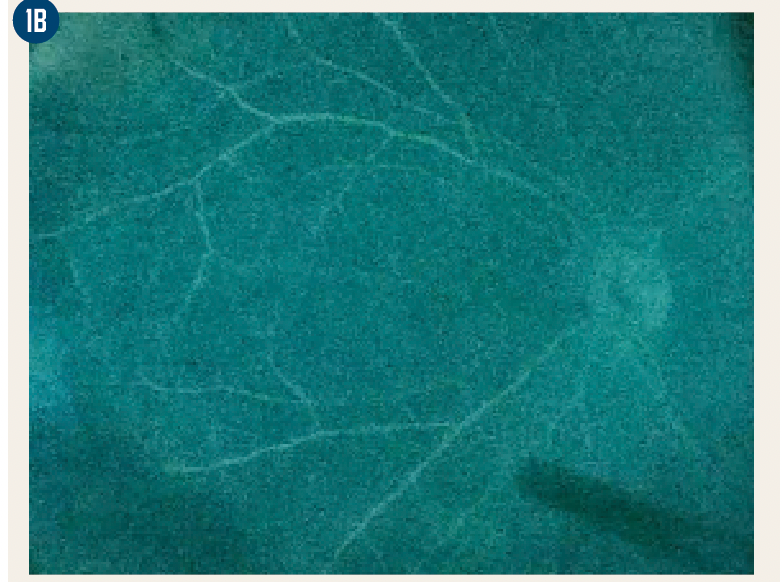 Intraoperative fluorescein angiography with fluorescein mode, patient with pars planitis with peripheral leakage. 