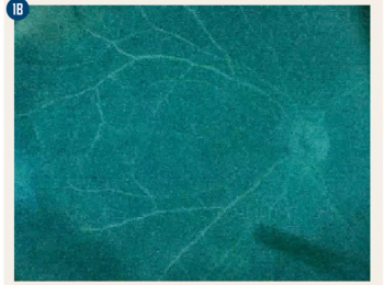 Intraoperative fluorescein angiography with fluorescein mode, patient with pars planitis with peripheral leakage.