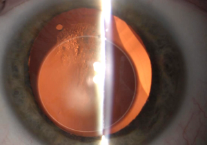 Insights on laser cataract surgery