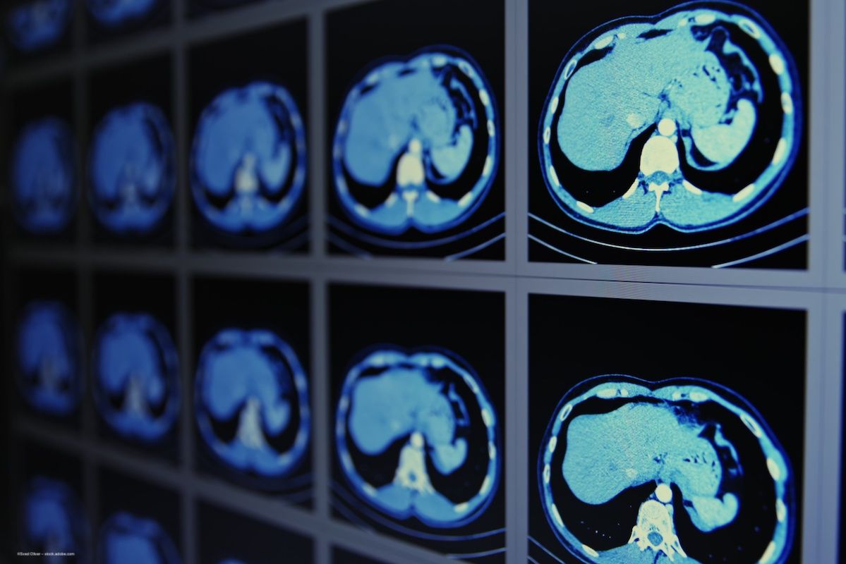 A series of kidney scans. Concept image for retinal biomarker scan, kidney function, lupus and autoimmune disease. Image credit: ©Sved Oliver – stock.adobe.com