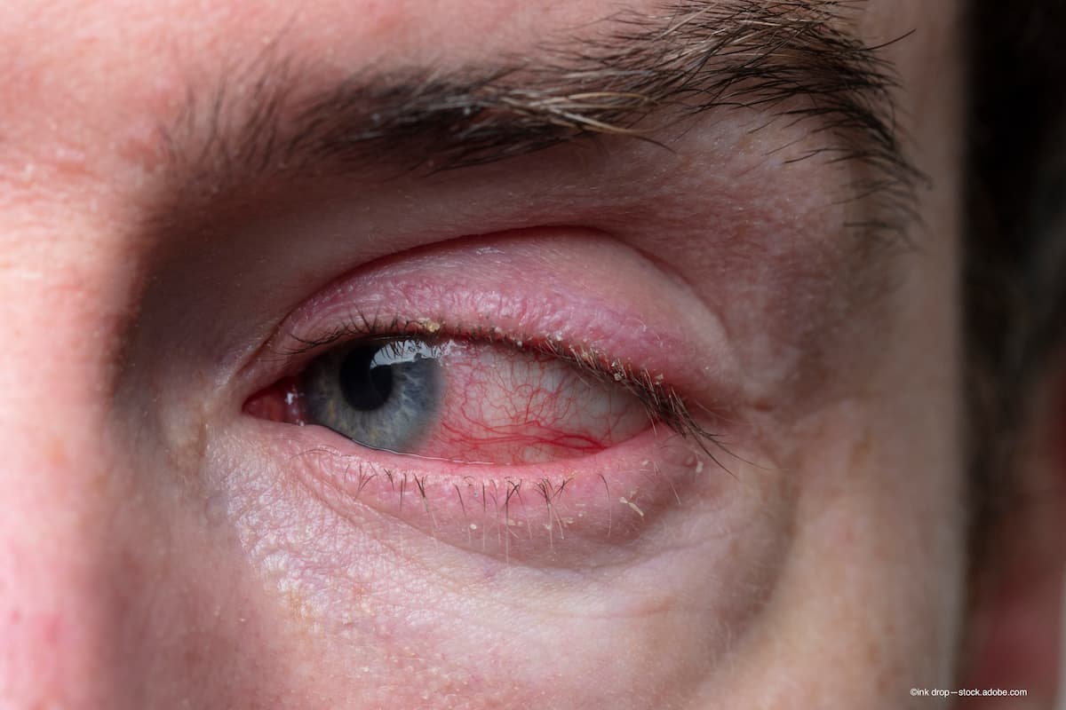 Positive topline data from Saturn-2 Phase 3 trial encourages Tarsus to file NDA in 2022