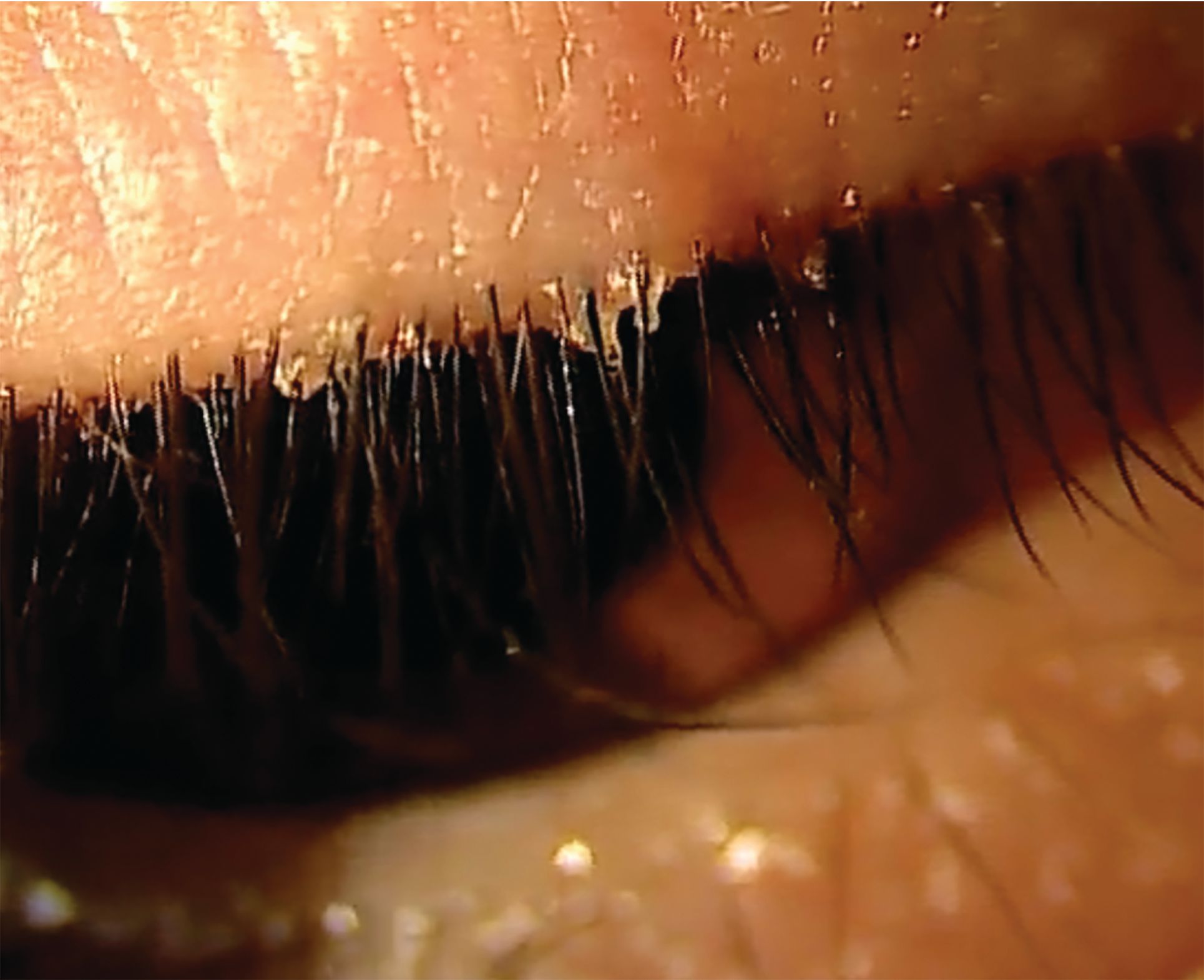 Shining new light on ocular surface care