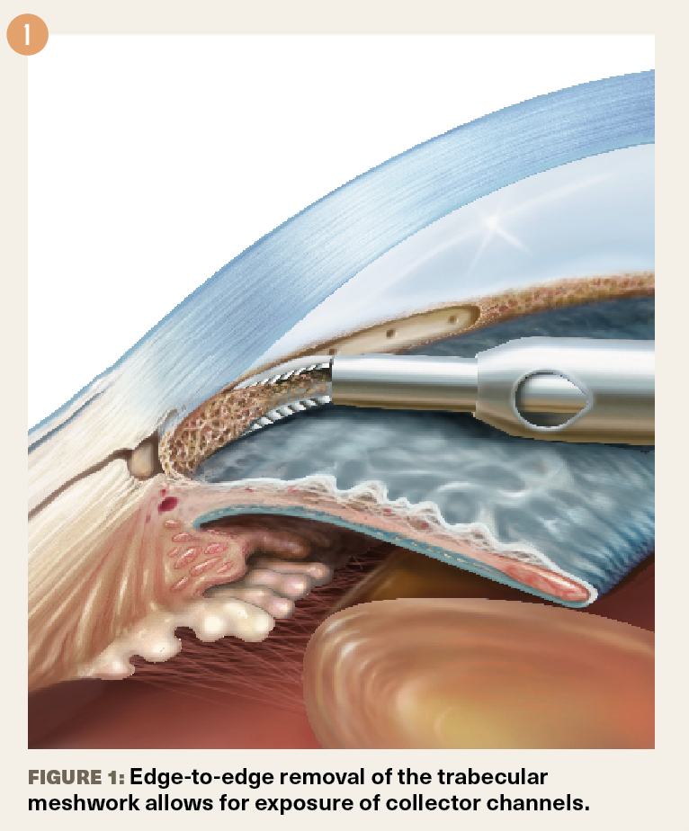 New goniotomy device + careful post-op care limits intraoperative bleeding