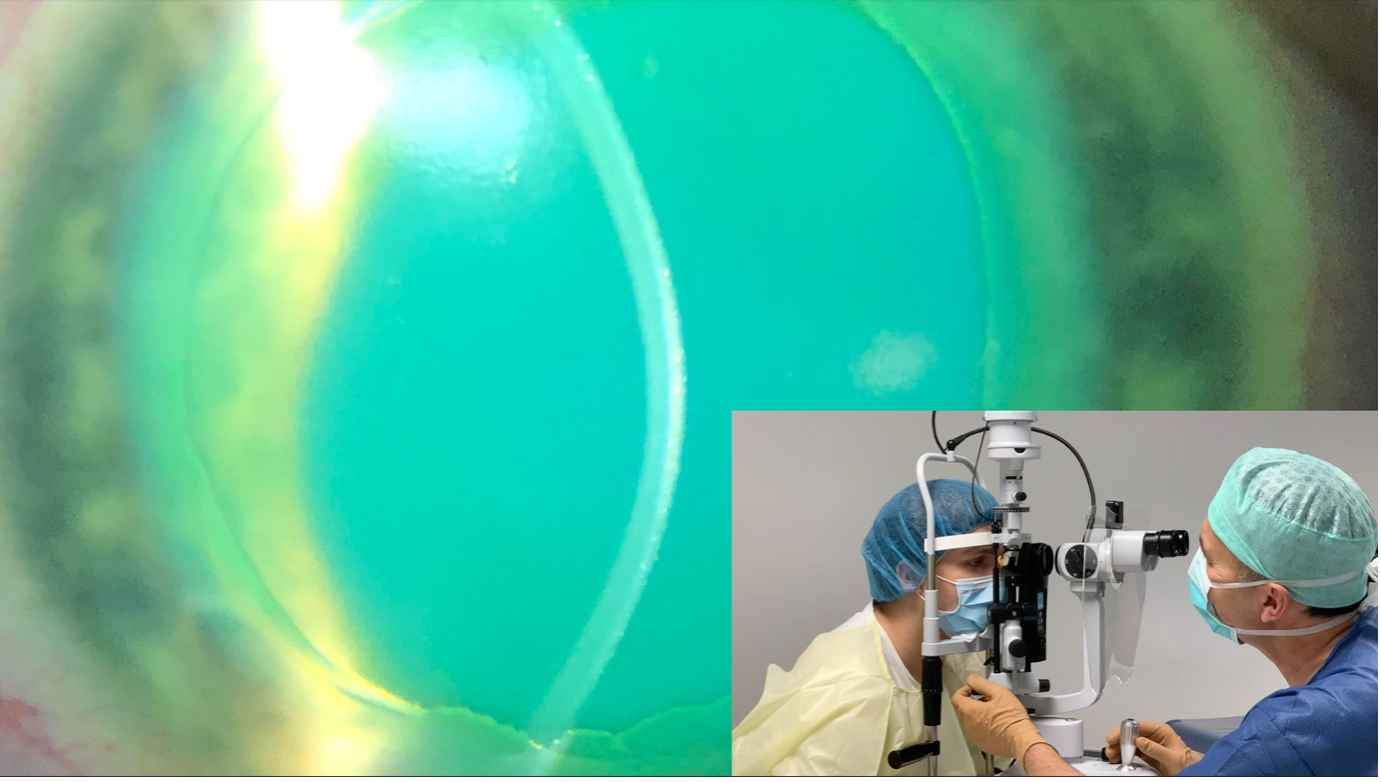 The pathophysiology and pathomorphology of corneal ectasia: Developments in corneal cross-linking therapy broaden its applications