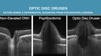 Manual segmentation of ocular images, titled, "OPTIC DISC DRUSEN establishing a differential diagnosis from pseudopapilloedema"