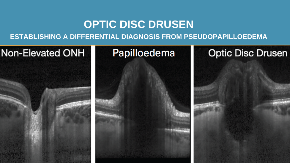 A field guide to optic disc drusen