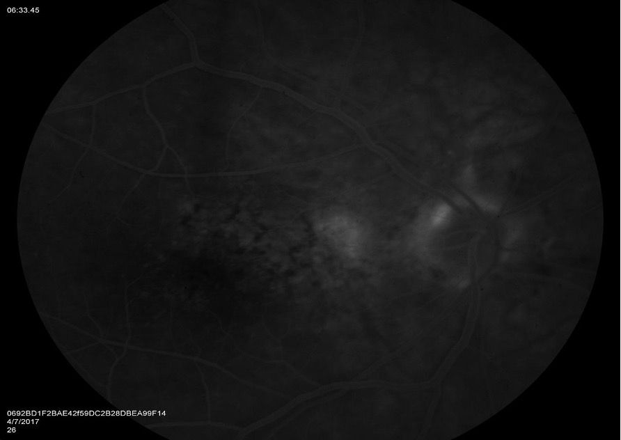 Figure 3. Late-phase fluorescein angiography revealed leakage consistent with a choroidal neovascular lesion temporal to the optic disc. This modality was instrumental in diagnosing the patient with wet age-related macular degeneration. 