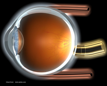 Portal extension trial: PDS maintains visual and anatomic benefits over long term