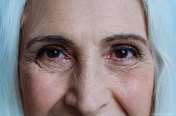 Study of bimatoprost implant reports IOP reduction for 2 years or more