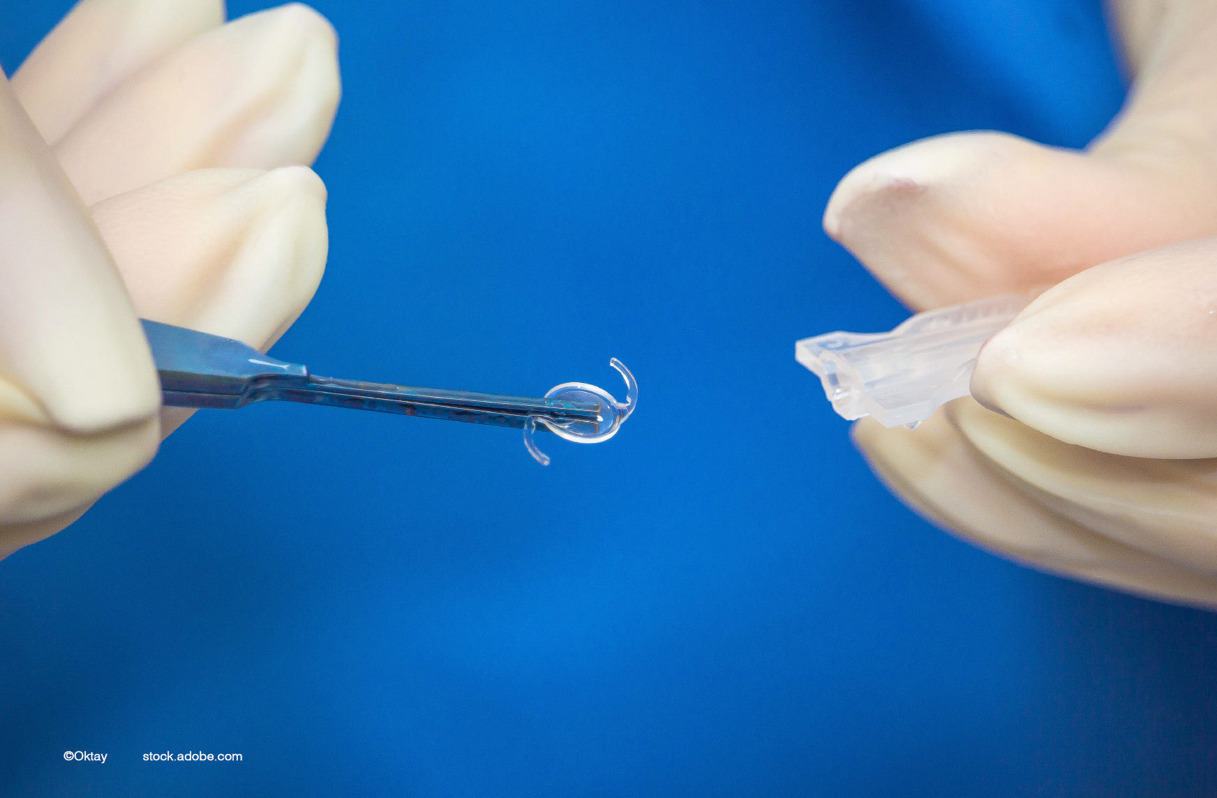Corneal ECD decrease continues after iris-fixated phakic IOL explanation