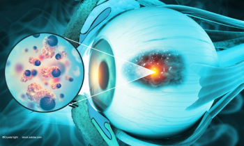 Local resection of choroidal melanoma