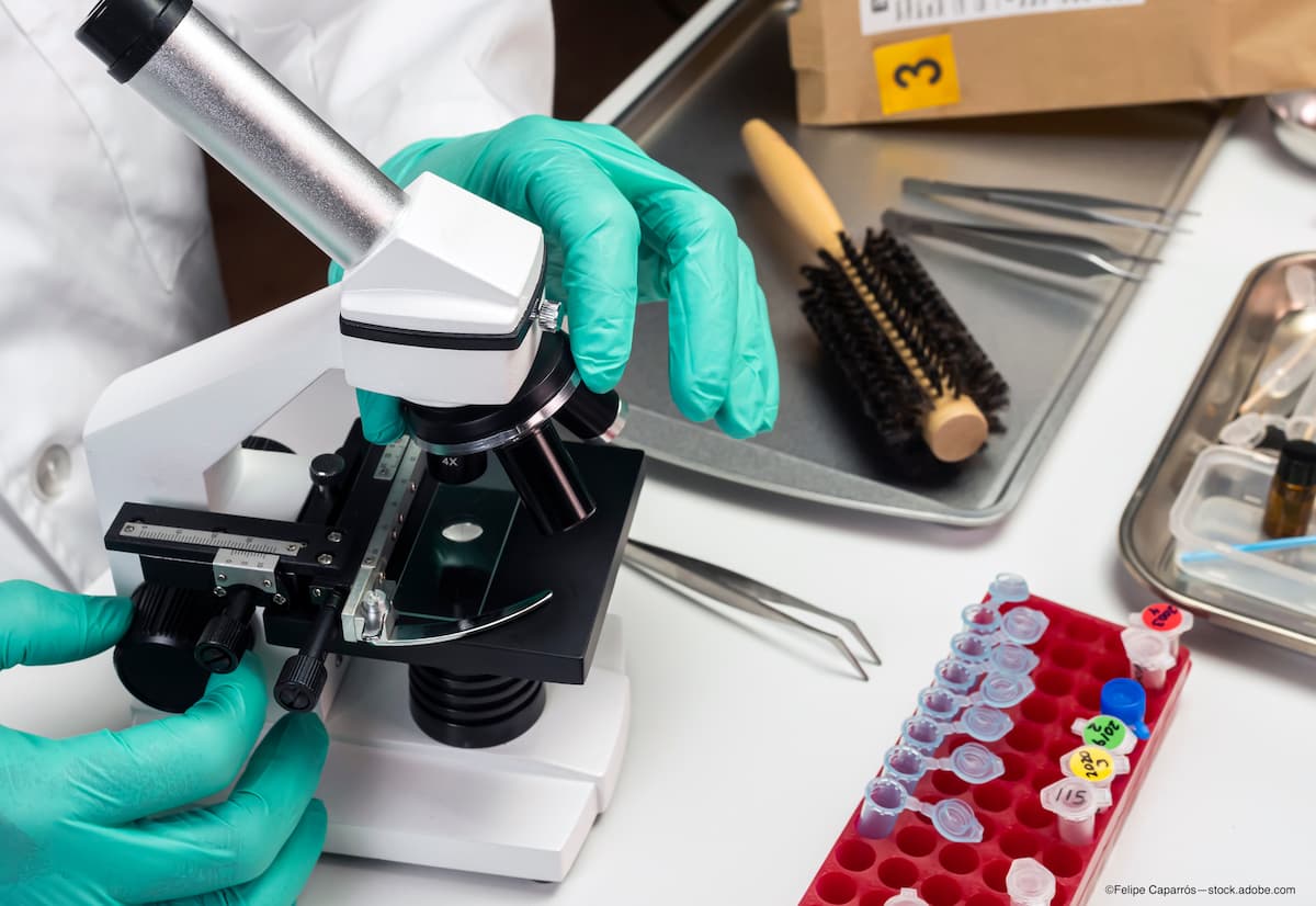 Hair cortisol may act as molecular biomarker for retinitis pigmentosa patients