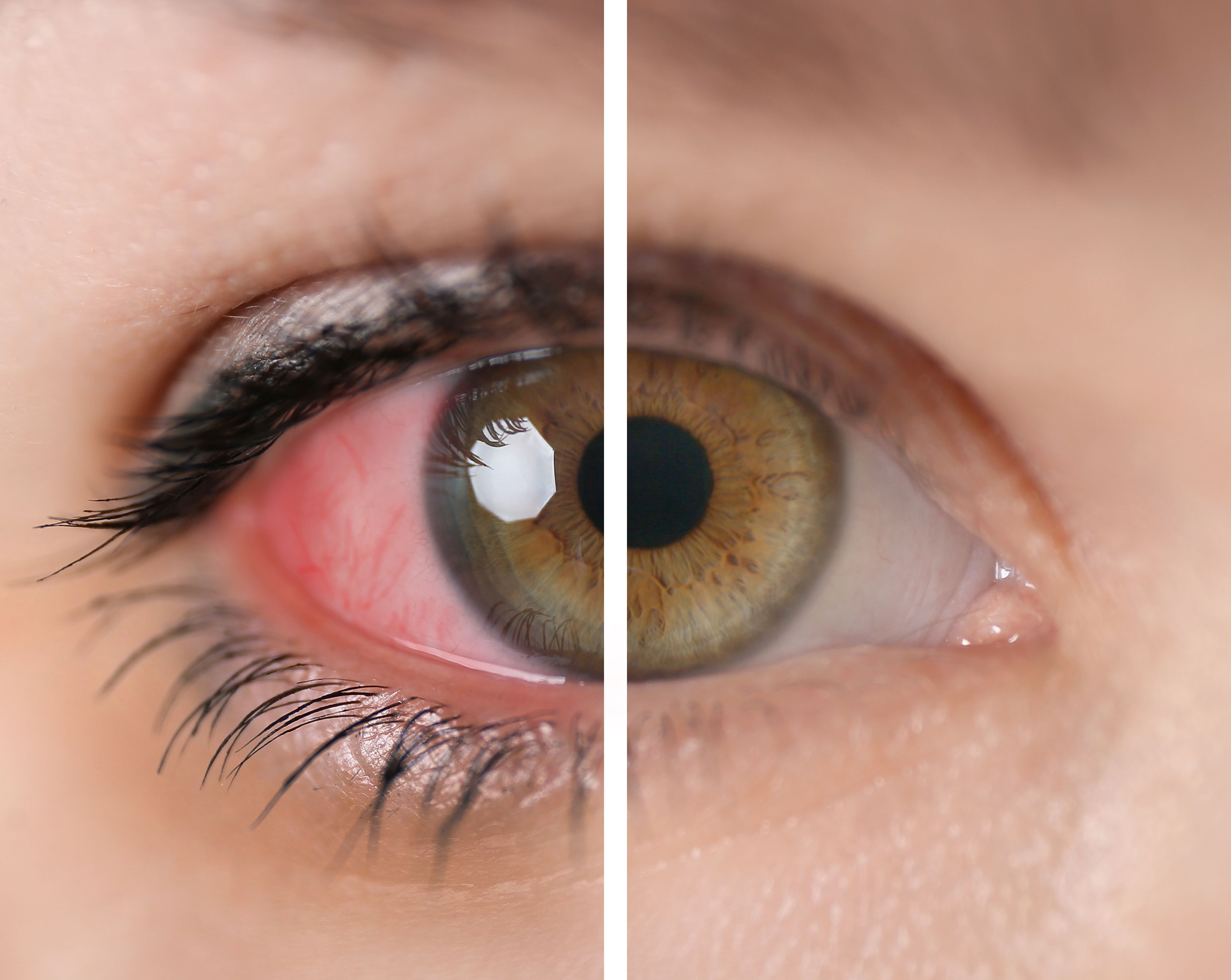 close up of woman's eye with red irritation