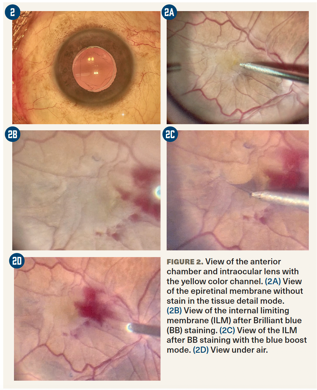 健康・医学 Vitreoretinal Surgery Vitreoretinal Surgery | Best Surgical Approaches For Surgery