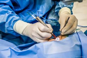 Biometric changes and endothelial cell loss after deep sclerectomy and trabeculectomy