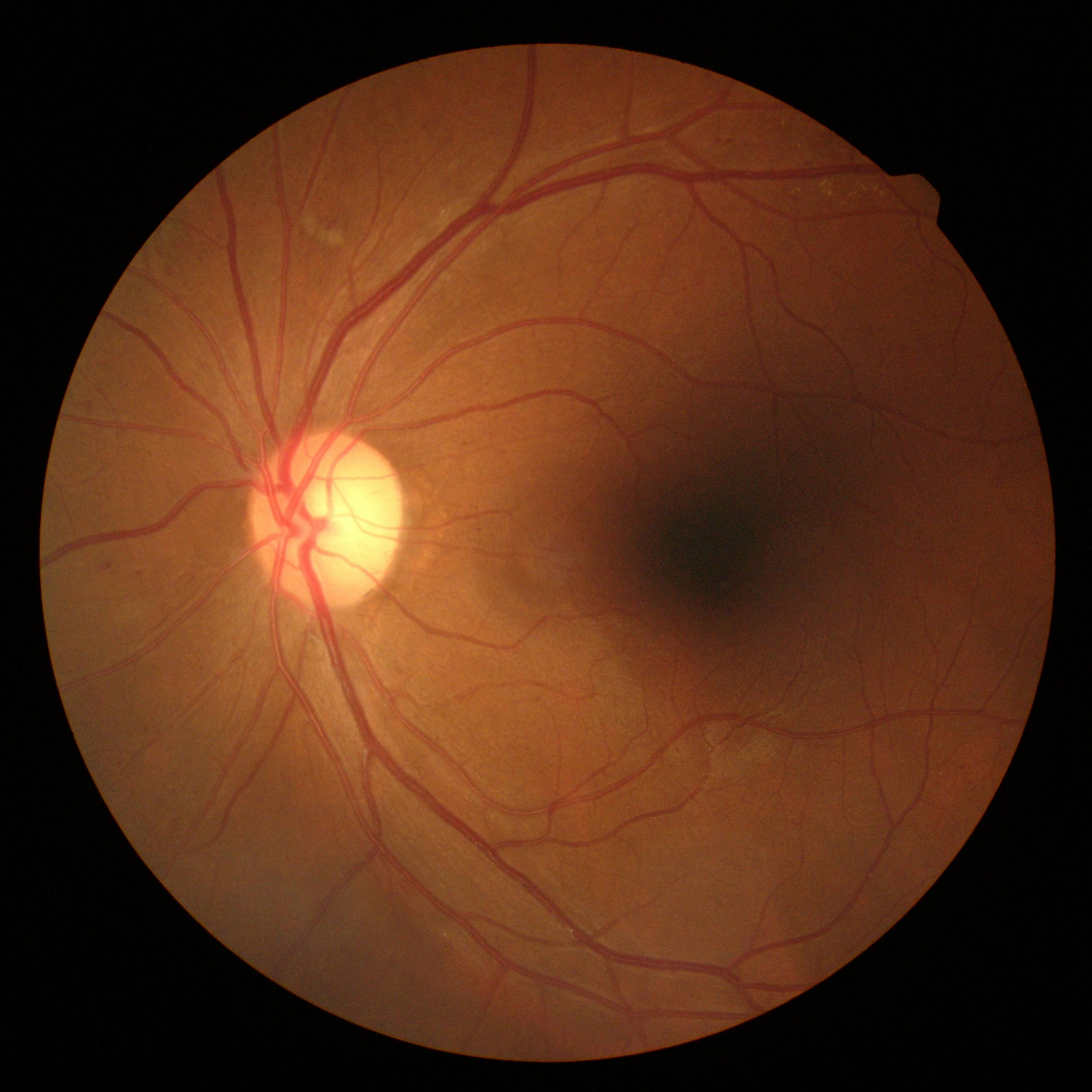 На сетчатку глаза за 3 с. Офтальмоскопия атрофия сетчатки. Флебогипертензивная глаукома. Отслойка сетчатки офтальмоскопия.