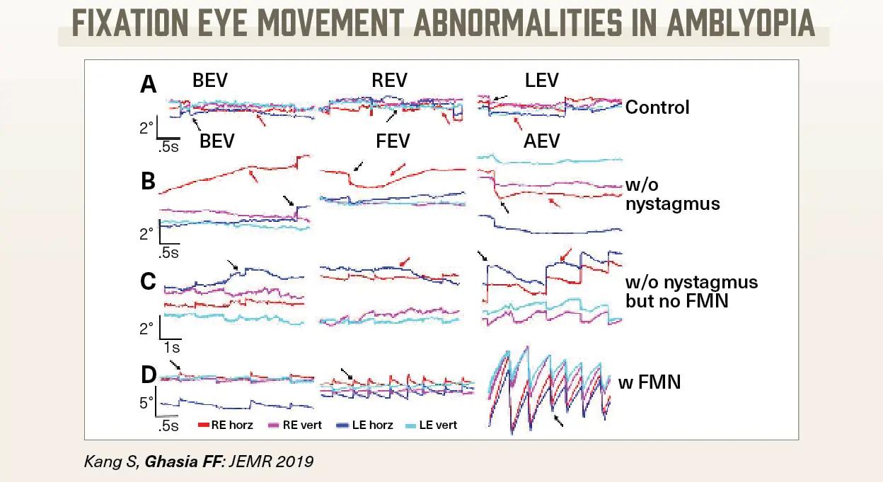 Fixation eye movement abnormalities in amblyopia