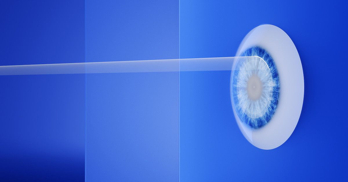 An illustration of a lens of a patient with hyperopia undergoing lenticule extraction surgery. Image courtesy of Carl Zeiss Meditec AG.