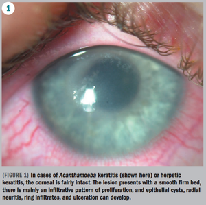 Slit-lamp biomicroscope workhorse tool for infectious keratitis diagnosis