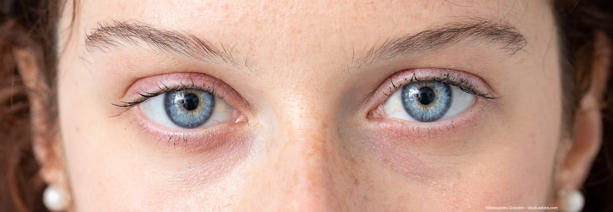 Newly identified molecular mechanism may lead to more therapies for retinitis pigmentosa 