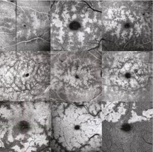 OCT images of eye