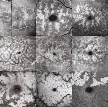 OCT images of eye