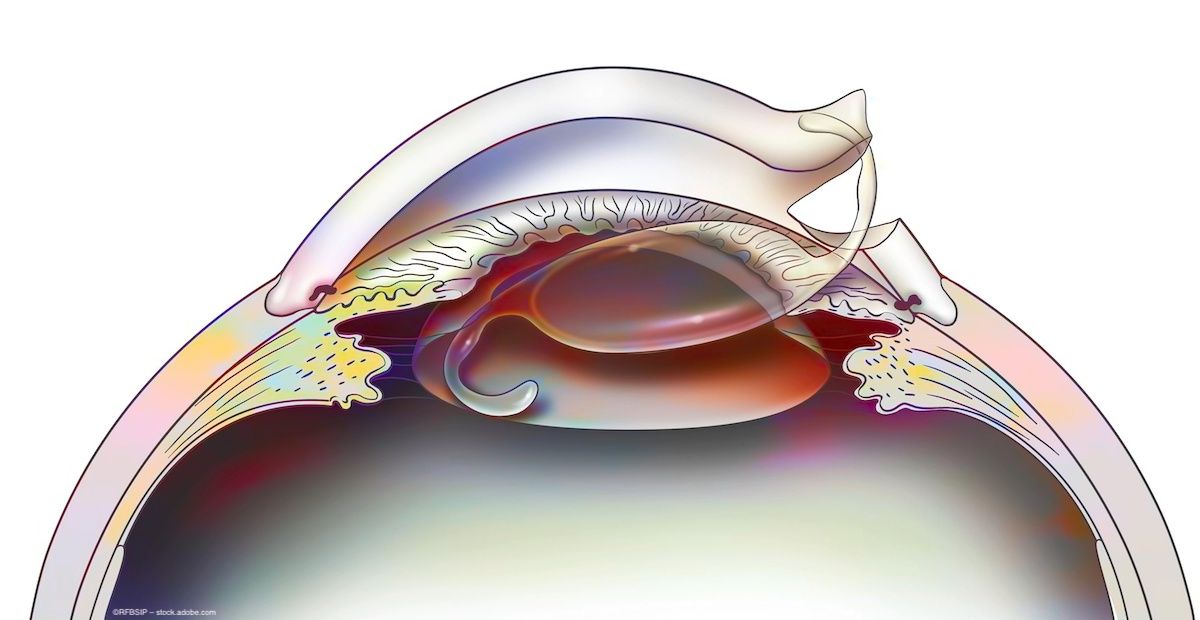 Focusing on functional vision with monofocal lenses