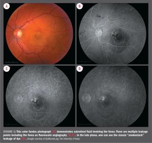Evaluating subthreshold laser technique for CSCR patients