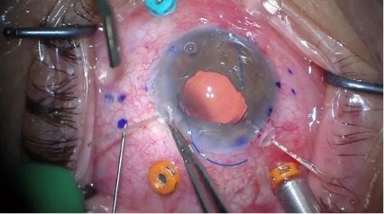 Capsule hooks are being used to secure the capsular bag during the phacoemulsification, it also holds the iris / pupil open