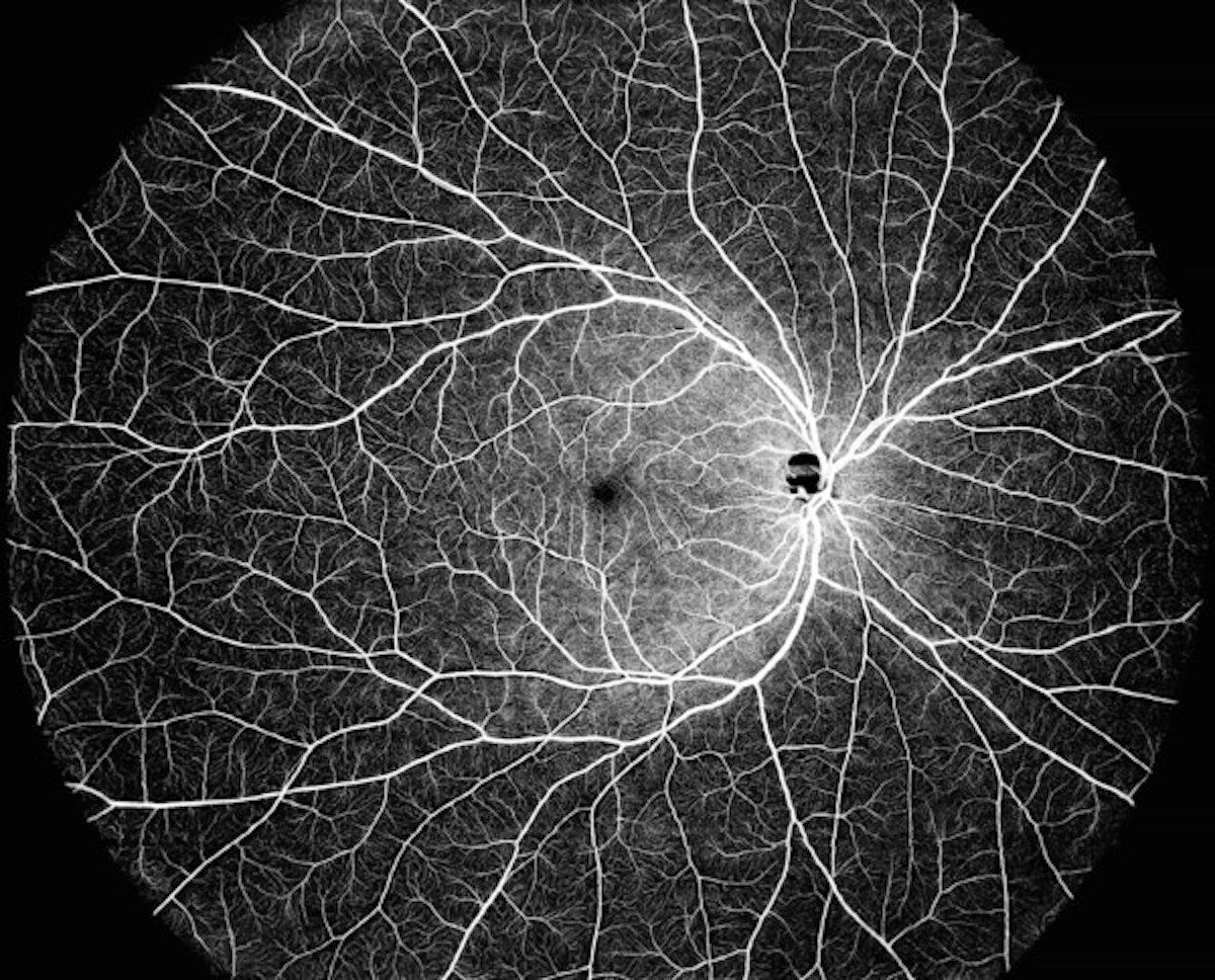 A single-shot, 130-degree OCTA image of the retina captured using DREAM OCT. Image courtesy of Intalight