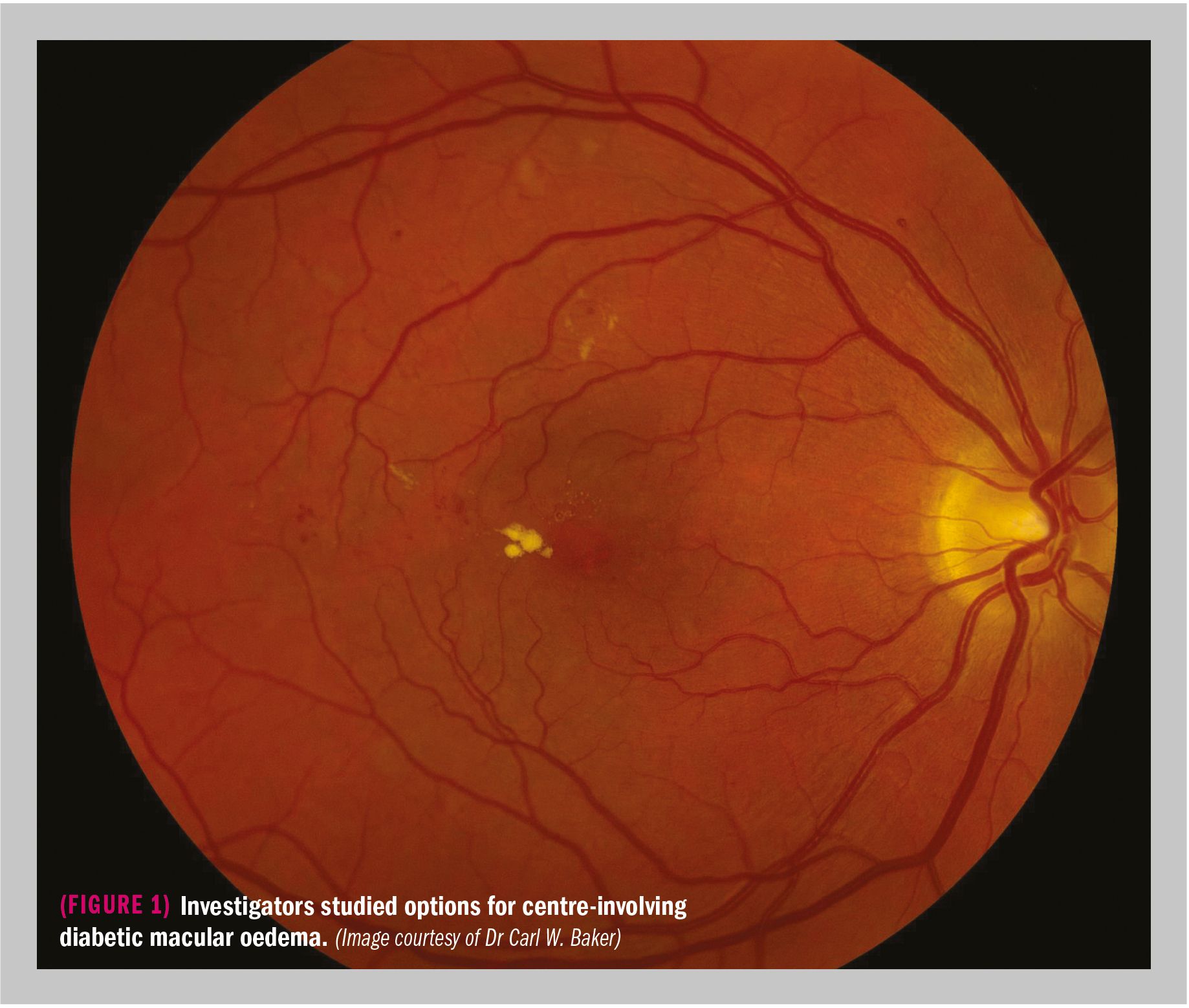 scan image of centre-involving diabetic macular oedema