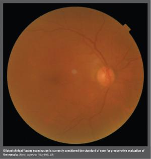 Macular OCT assists preop cataract surgery evaluation