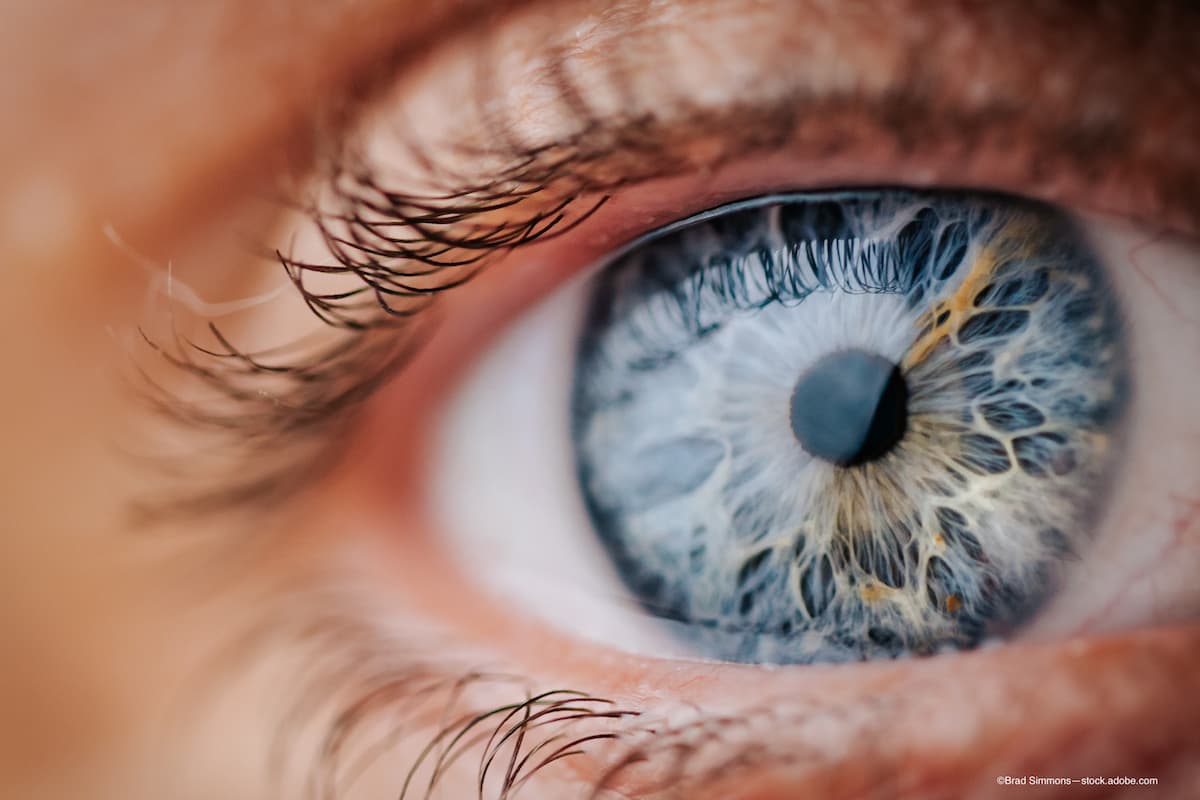 Cataract predictability: Screen and treat unstable tear film in weeks