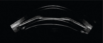 Very-high-frequency ultrasound improves ICL sizing precision