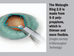 Next-generation device helpful in managing inadequate pupil dilation