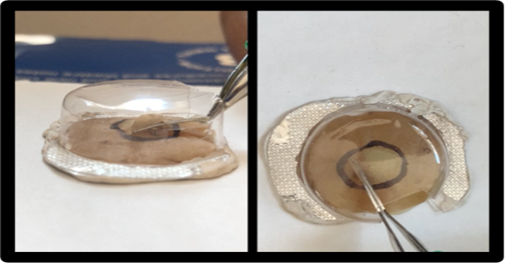 Figure 3C. Using a cystotome, create a 'capsular flap.' Using the forceps, complete the simulated rhexis as guided by the circular markings.