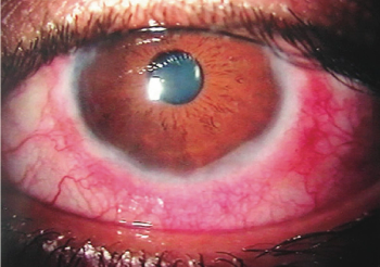 Circumnavigating the bumpy road to vernal keratoconjunctivitis: Time is key
